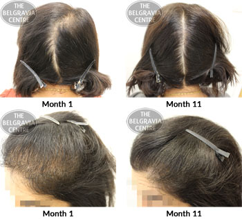 alert female pattern hair loss the belgravia centre 24 05 2018