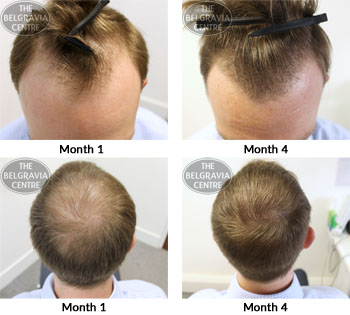 alert male pattern hair loss the belgravia centre 17 05 2018
