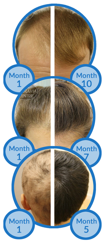 Belgravia Hair Loss Treatment Success Stories - Male Pattern Baldness - Female Pattern Hair Loss - Alopecia Areata
