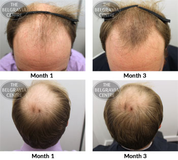 alert male pattern hair loss the belgravia centre 10 05 2018