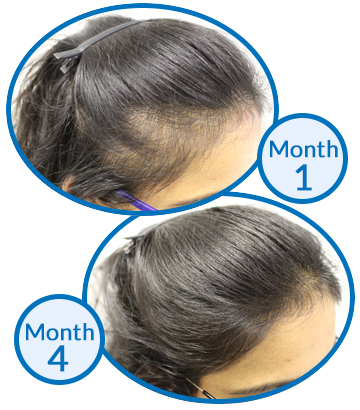 Womens-Hair-Loss-Belgravia-Centre-Female-Pattern-Hair-Loss-Treatment-Success-Story-Regrowth