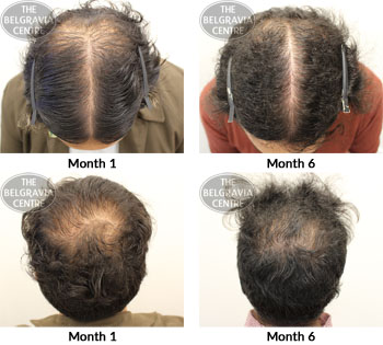 alert male pattern hair loss the belgravia centre 26 04 2018