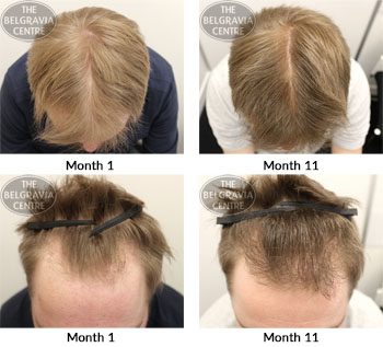 alert male pattern hair loss the belgravia centre 17 04 2018