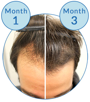 Minoxidil Only Male Pattern Hair Loss Treatment Success Story Belgravia Centre Men's Hair Growth Client