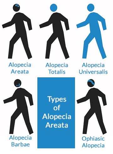 Diagram Belgravia Centre Different Types of Alopecia Areata autoimmune hair loss