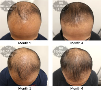 alert male pattern hair loss the belgraviacentre 22 03 2018