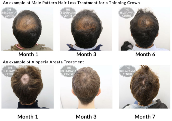 Advice On Treating Bald Spot Caused By Male Pattern Hair Loss'
