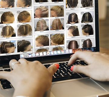 Belgravia Centre hair loss clinic womens hair loss treatment regrowth success stories