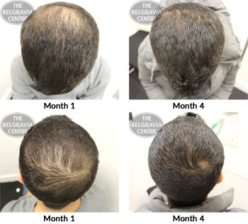 alert male pattern hair loss the belgravia centre 12 03 2018