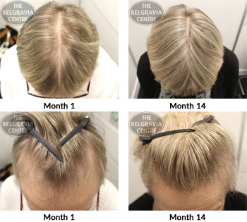 alert female pattern hair loss the belgravia centre 07 03 2018