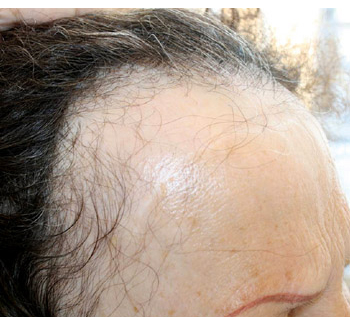 Example of Frontal Fibrosing Alopecia