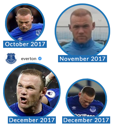 Did Wayne Rooney Have Another Hair Transplant?