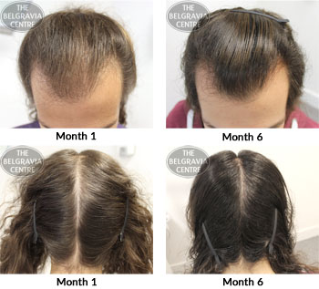 alert male pattern hair loss the belgravia centre 05 02 2018
