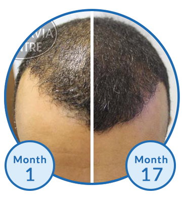 Success Story Male Pattern Baldness Hair Loss Treatment Belgravia Centre Receding Hairline