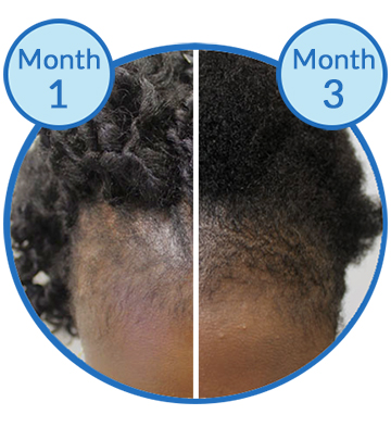 Belgravia Centre client Traction Alopecia hair loss treatment before and after success story