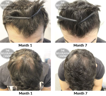 alert male pattern hair loss the belgravia centre 29 01 2018