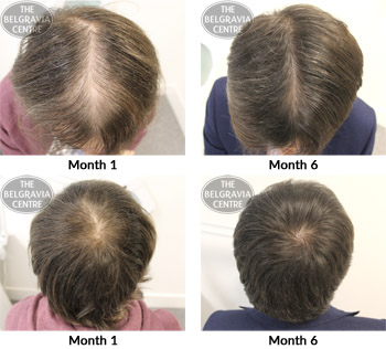alert male pattern hair loss the belgravia centre 25 01 2018