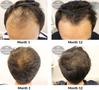 alert male pattern hair loss the belgravia centre 22 01 2018