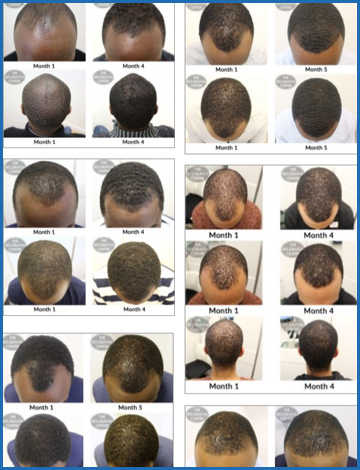 Is It True Nothing Can Be Done About Male Pattern Baldness?'