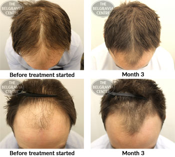 book commment male pattern hair loss the belgravia centre 18 01 18