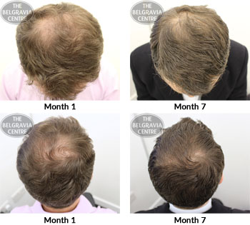 alert male pattern hair loss the belgravia centre 15 01 2018