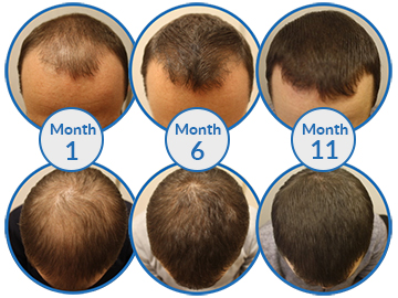 Male Pattern Baldness hair loss treatment results Belgravia Centre clinic London