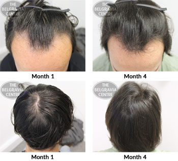 alert male pattern hair loss the belgravia centre 05 01 18