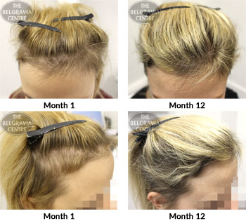 alert female pattern hair loss the belgravia centre 03 01 2018