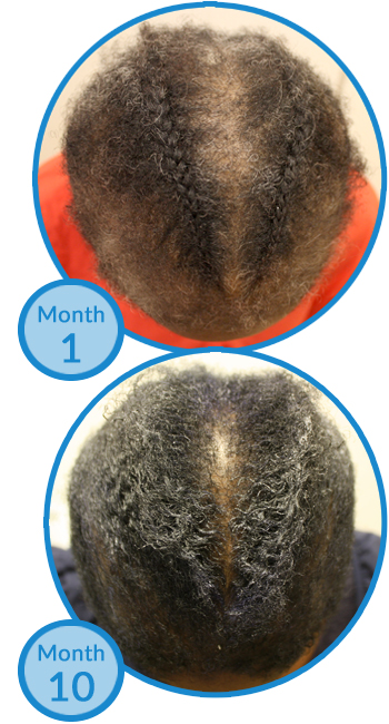Belgravia Centre Hair Loss Treatment Success Story - Female Client with FDG and Traction Alopecia