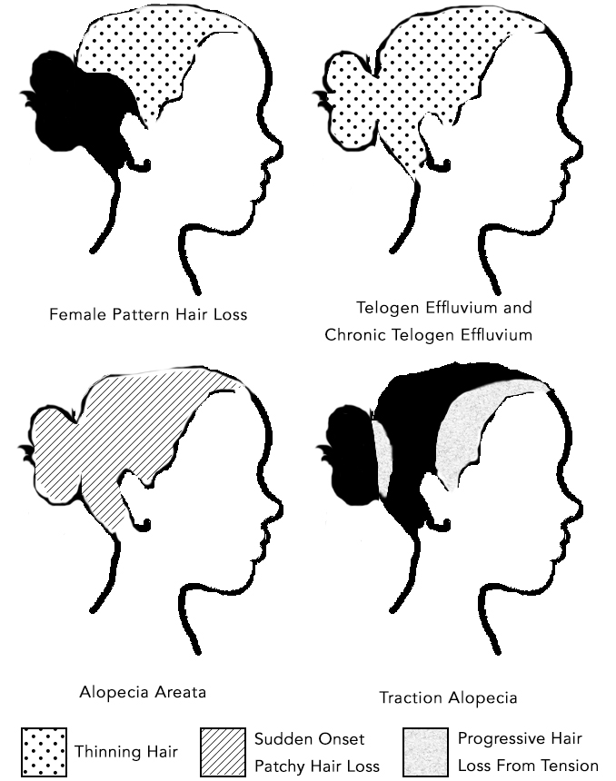 Types of Womens Hair Loss and The Areas of The Scalp Affected