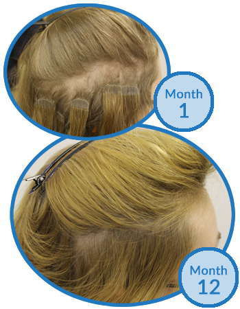 Traction Alopecia Treatment Belgravia Centre Success Story - Hair Extensions