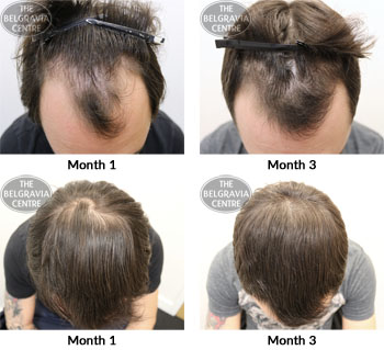 alert male pattern hair loss the belgravia centre 21 11 2017