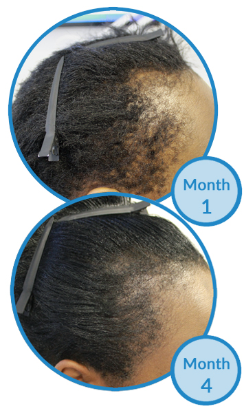 Belgravia Centre Traction Alopecia Treatment Client Regrowth Results