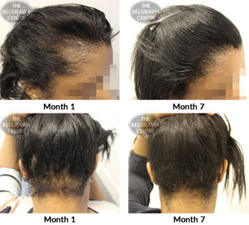 alert female pattern hair loss traction alopecia the belgravia centre 10 11 2017