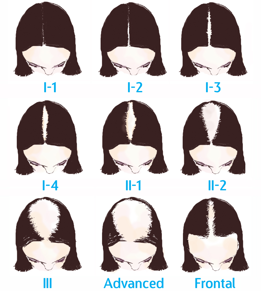 Why It's Female Pattern Hair Loss Not Female Pattern Baldness