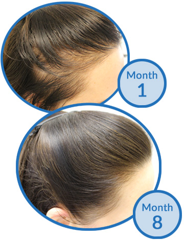 Belgravia Centre Success Story - Female Pattern Hair Loss before and after treatment client hair growth