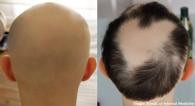 tofactinib-case-study-man-with-alopecia-universalis-regrows-hair