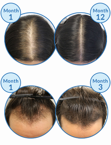 Belgravia Centre Hair Loss Treatment Success Male Pattern Baldness Women's Hair Growth