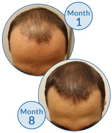 Male Pattern Baldness Belgravia Hair Loss Treatment Hair Growth Success Story Client MPB