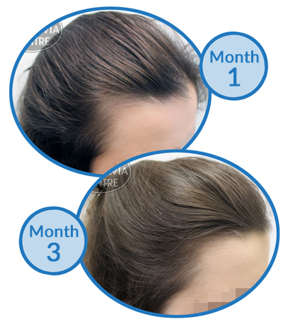 telogen-effluvium-treatment-womens-hair-loss-belgravia-centre-client