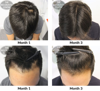 alert male pattern hair loss the belgravia centre 27 09 17