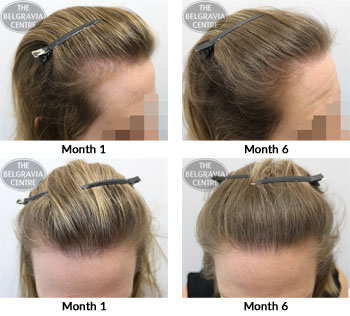 alert female pattern hair loss chronic telogen effluvium the belgravia centre 22 09 17