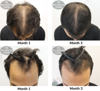 alert male pattern hair loss the belgravia centre 20 09 17