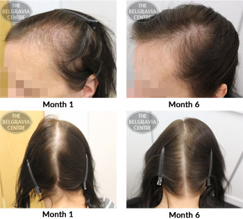 alert female pattern hair loss the belgravia centre 15 09 17