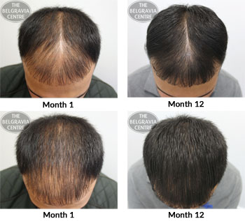 alert male pattern hair loss the belgravia centre 15 09 17