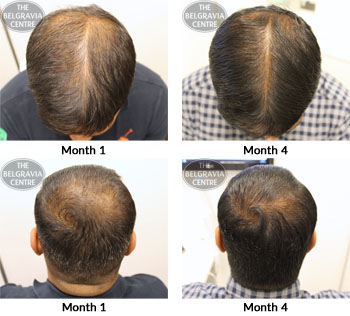 alert male pattern hair loss the belgravia centre 13 09 17