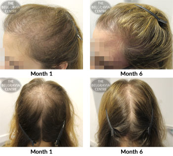 alert female pattern hair loss the belgravia centre 07 09 17