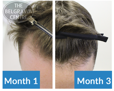 This Belgravia Centre Client Has Seen His Receding Hairline Start to Fill in with Regrowth After 3 Months of Treatment