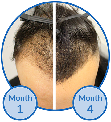 Belgravia Centre Hair Loss Treatment Receding Hairline mpb client Success Story