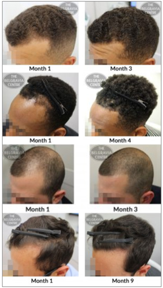 Belgravia Centre receding hairline treatment male hair loss before and after client photos